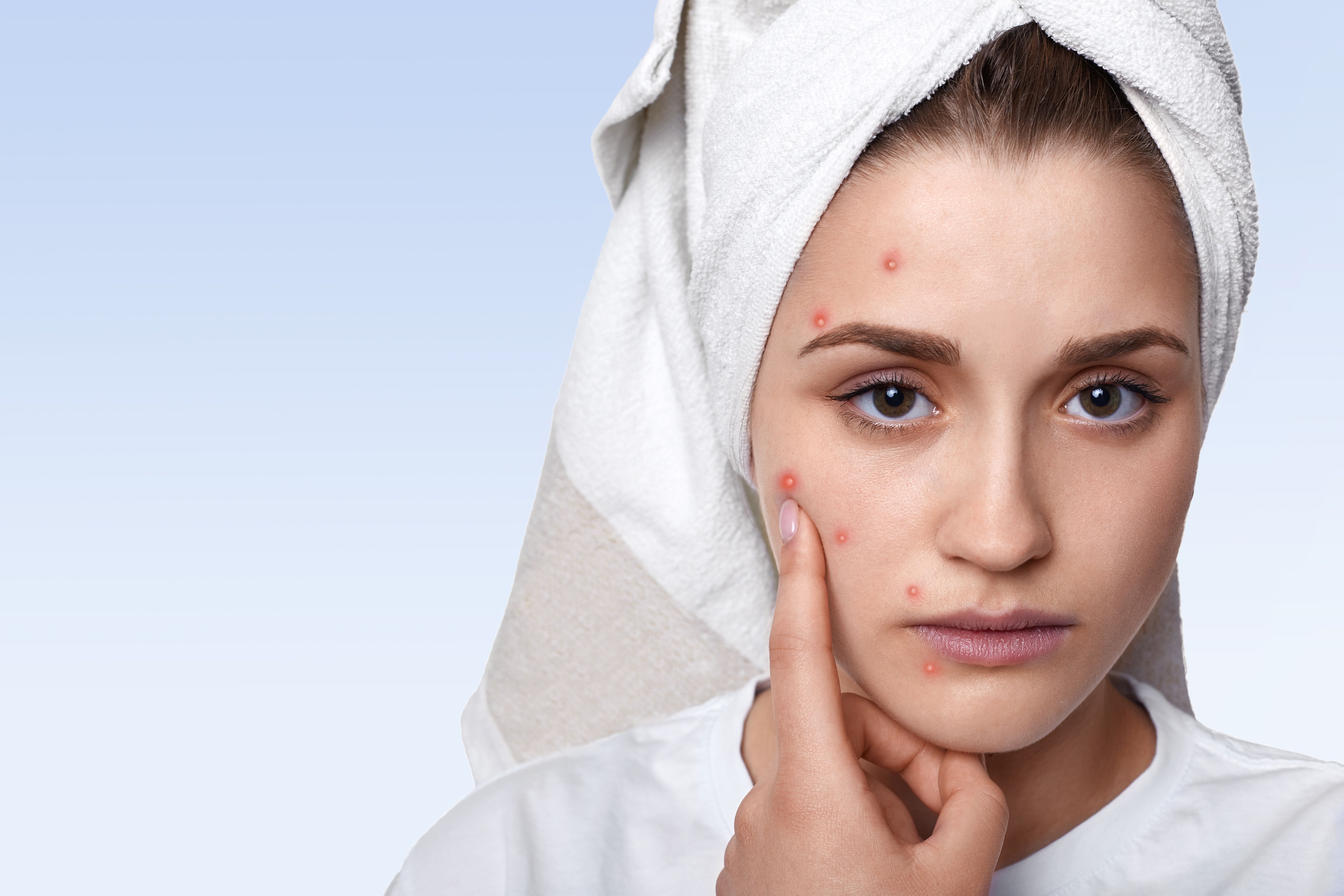 Debunking all the ‘Acne Myths’ 