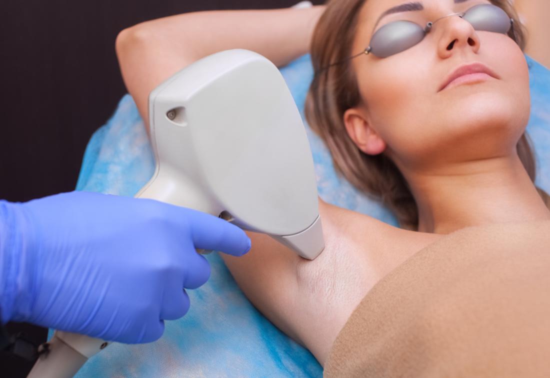 Trying Laser Hair Removal